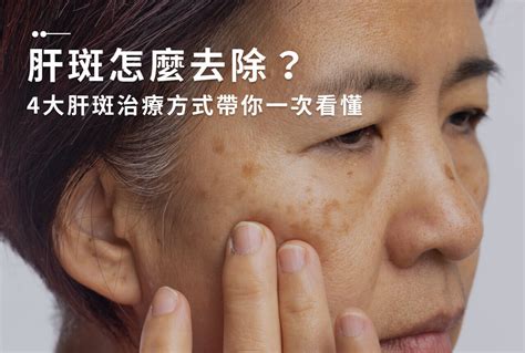 臉部有斑|一次解析曬斑、肝斑、雀斑、顴骨母斑等皮膚黑斑原因…